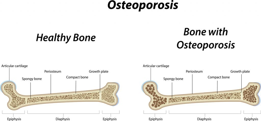 osteoporosis