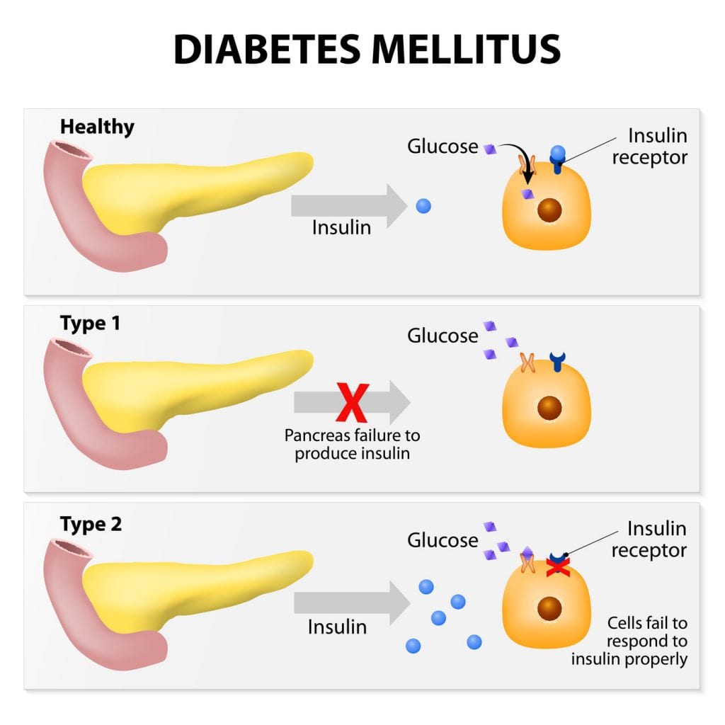 diabetes overview